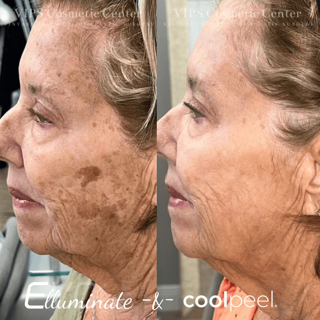 coolpeel