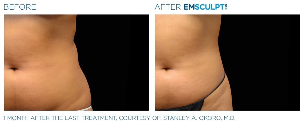 Emsculpt Neo Abdomen 1