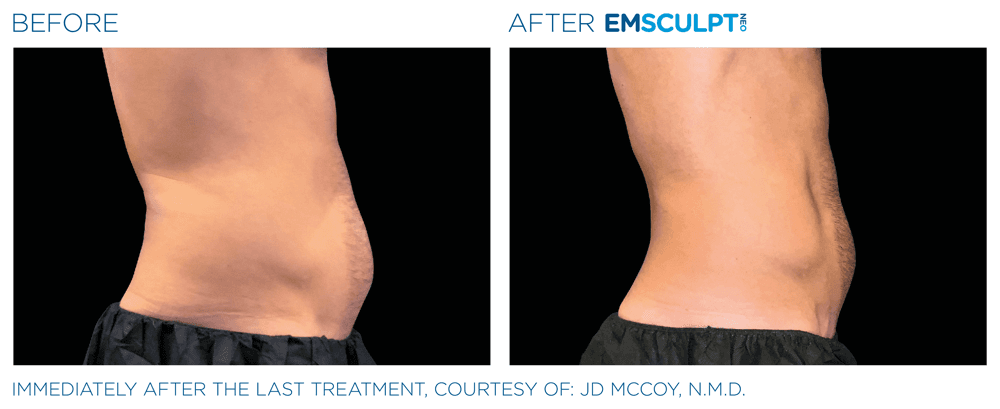 Emsculpt Neo Abdomen 10