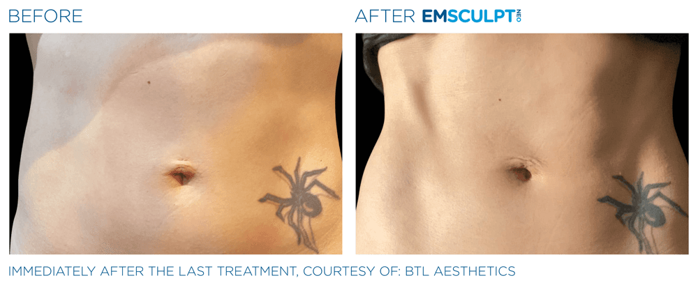 Emsculpt Neo Abdomen 12