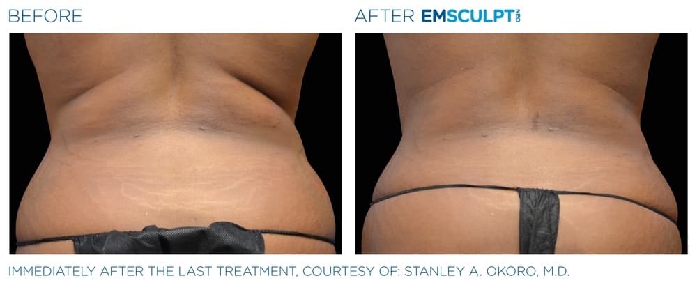 Emsculpt Neo Abdomen 2