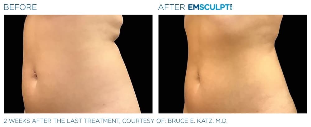 Emsculpt Neo Abdomen 3