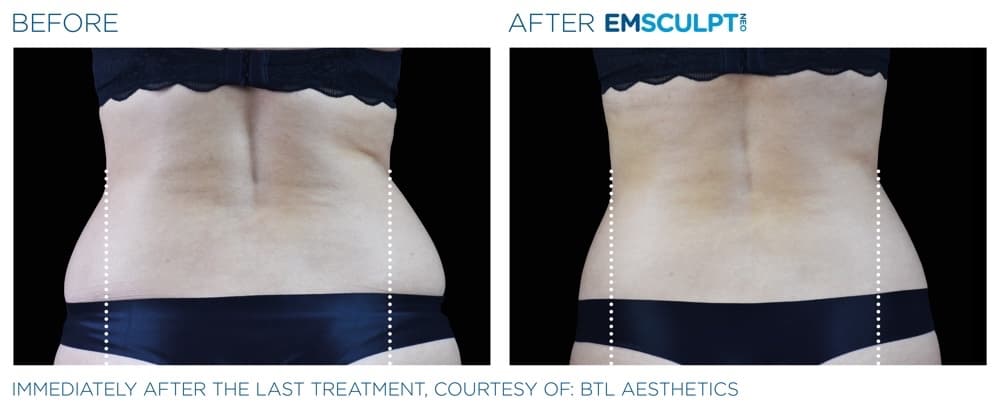 Emsculpt Neo Abdomen 4