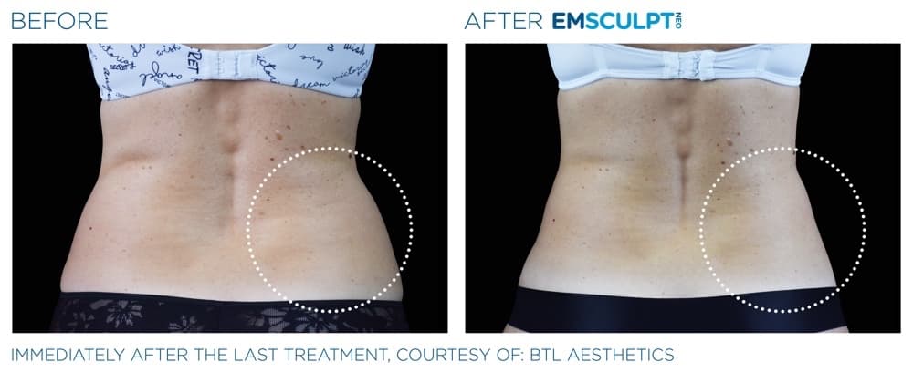 Emsculpt Neo Abdomen 5