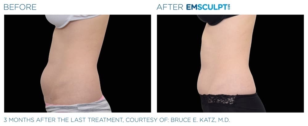 Emsculpt Neo Abdomen 7