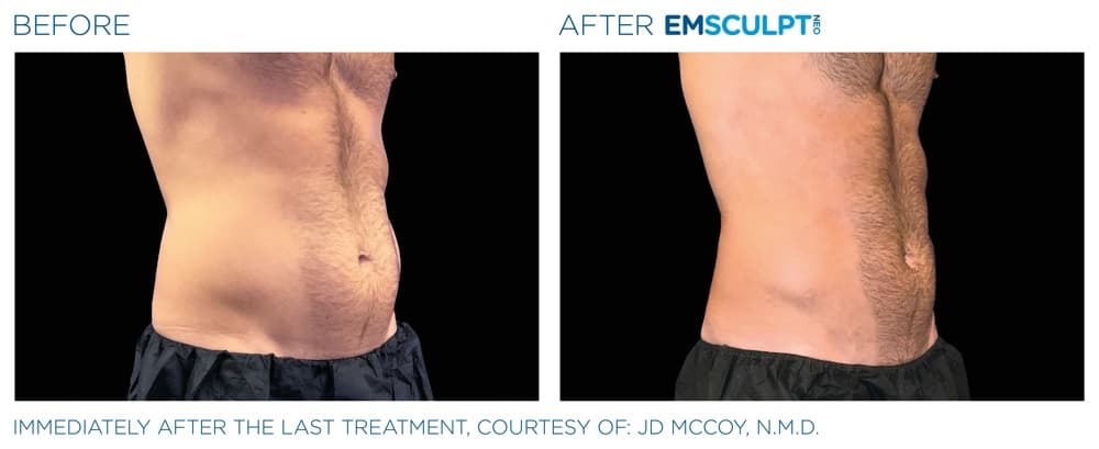 Emsculpt Neo Abdomen 8