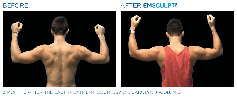 Emsculpt Neo Arms 6