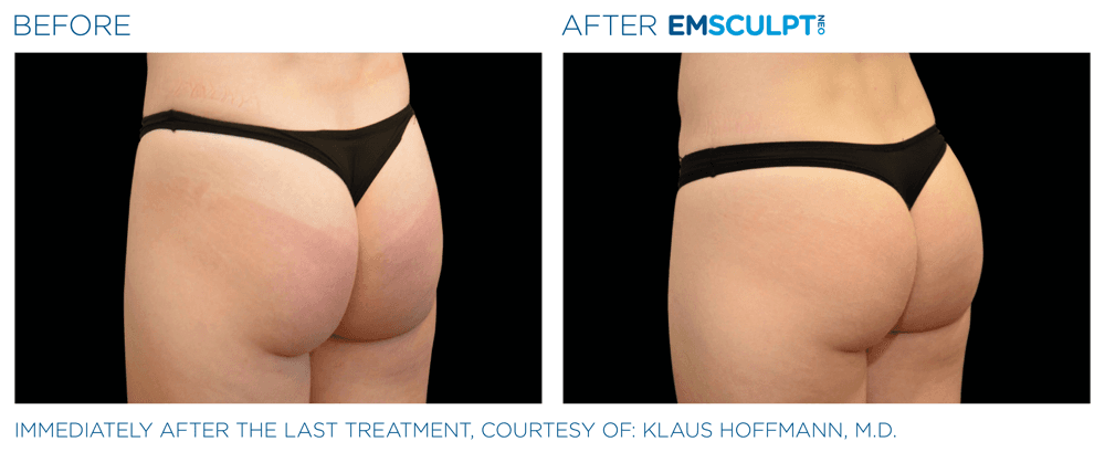 Emsculpt Neo Buttocks 3