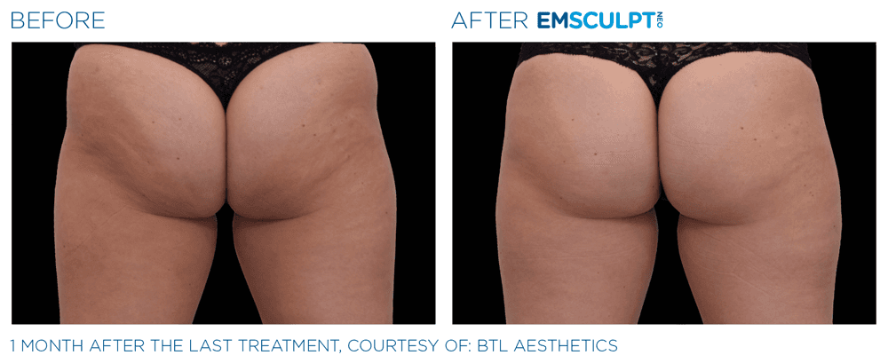 Emsculpt Neo Buttocks 5
