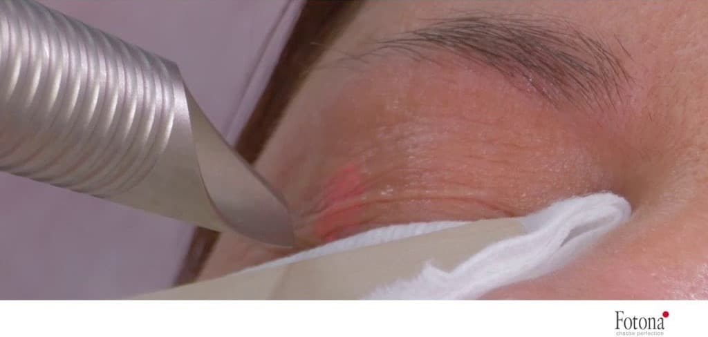 Fotona SMOOTH® Eyecut