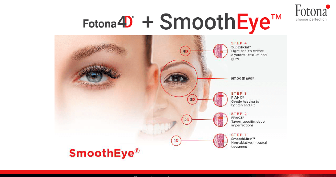 Fotona SMOOTH® EYE
