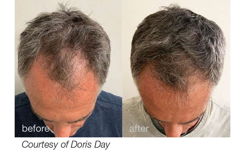 Fotona Laser Treatment