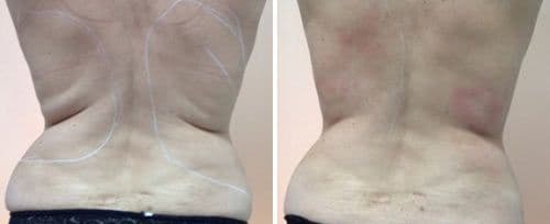 Fotona Laser Treatment