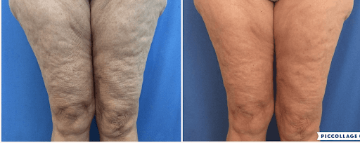 Fotona Laser Treatment