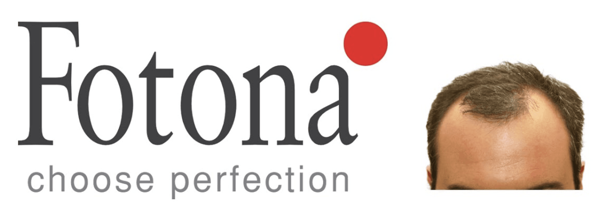 Fotona Laser Treatment