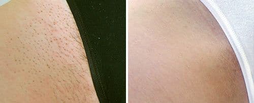 Fotona Laser Treatment