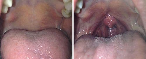 Fotona Laser Treatment