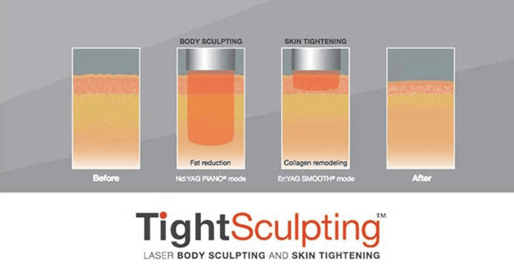 Fotona Laser Treatment Tight Sculping