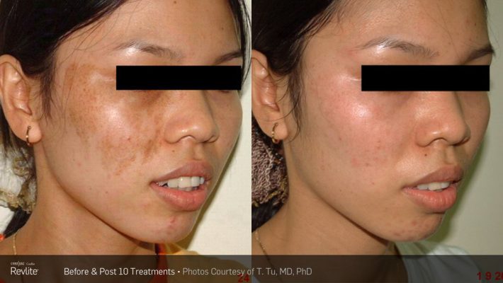PicoSure