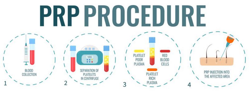Platelet Rich Plasma