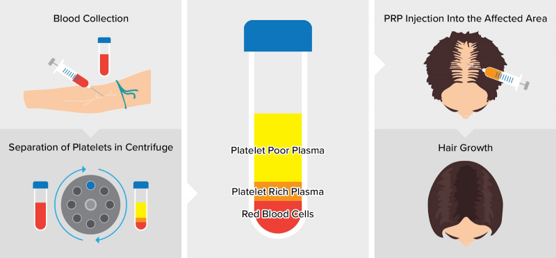 Platelet Rich Plasma