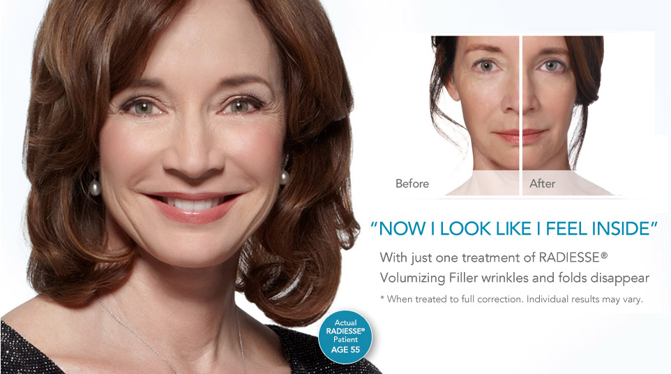 Woman 1 - Radiesse