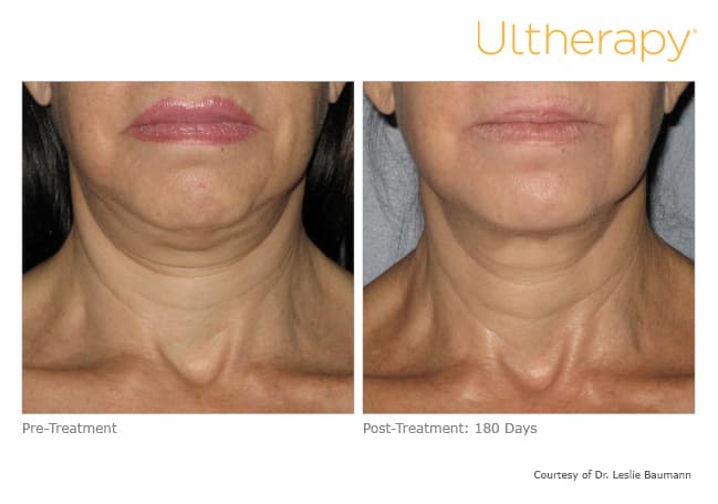 ultherapy gold standard
