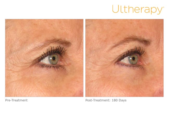 ultherapy gold standard
