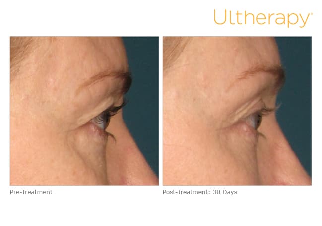 ultherapy gold standard