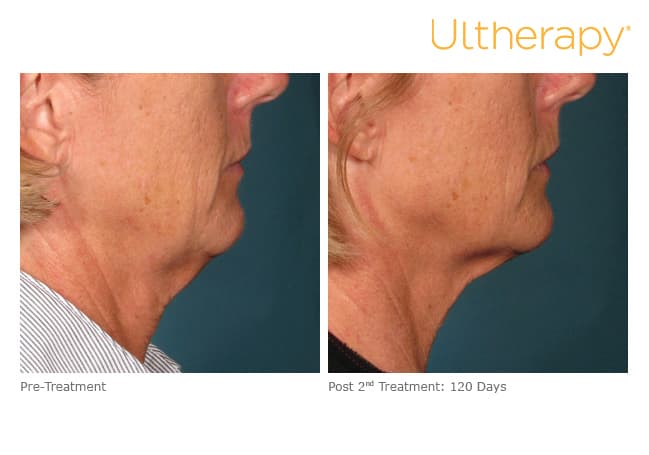 ultherapy gold standard