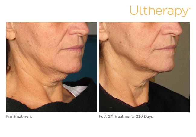 ultherapy gold standard