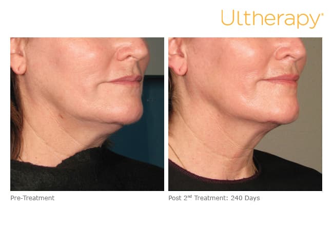 ultherapy gold standard