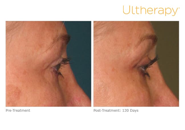 ultherapy gold standard
