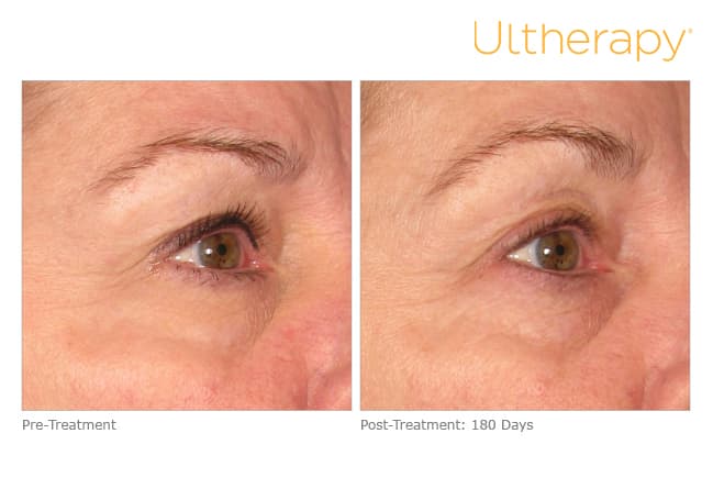 ultherapy gold standard