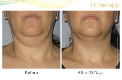ultherapy gold standard