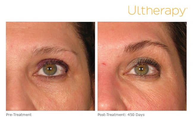 ultherapy gold standard