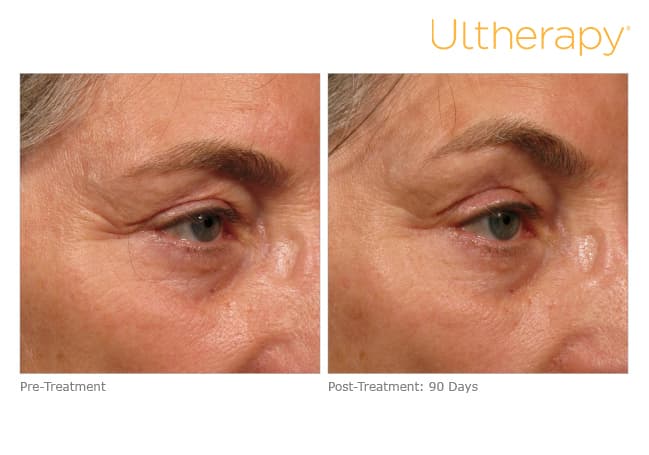 ultherapy gold standard