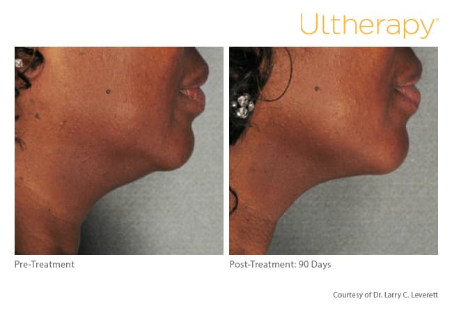 ultherapy gold standard