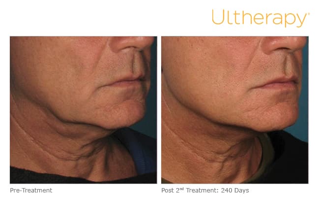 ultherapy gold standard