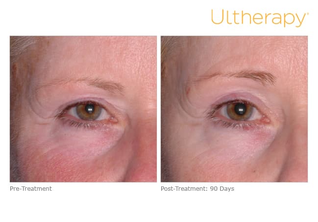 ultherapy gold standard