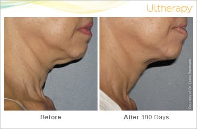 ultherapy gold standard