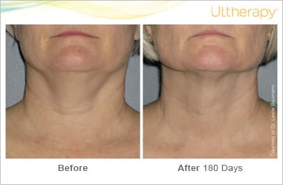 ultherapy gold standard