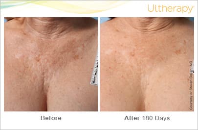 ultherapy gold standard