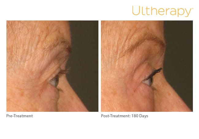 ultherapy gold standard