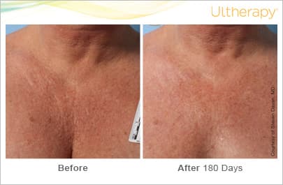 ultherapy gold standard