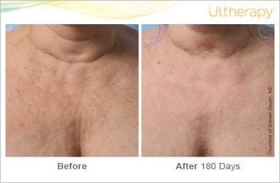 ultherapy gold standard