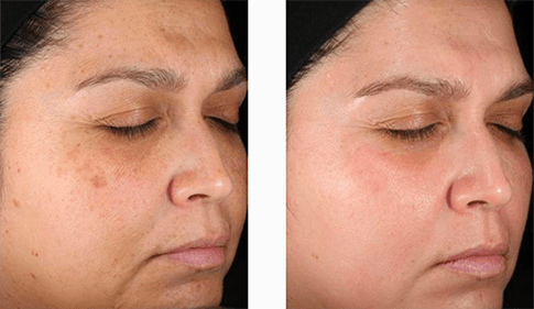 Before and after pigmentation and brightening treatment on the cheek, shown side by side