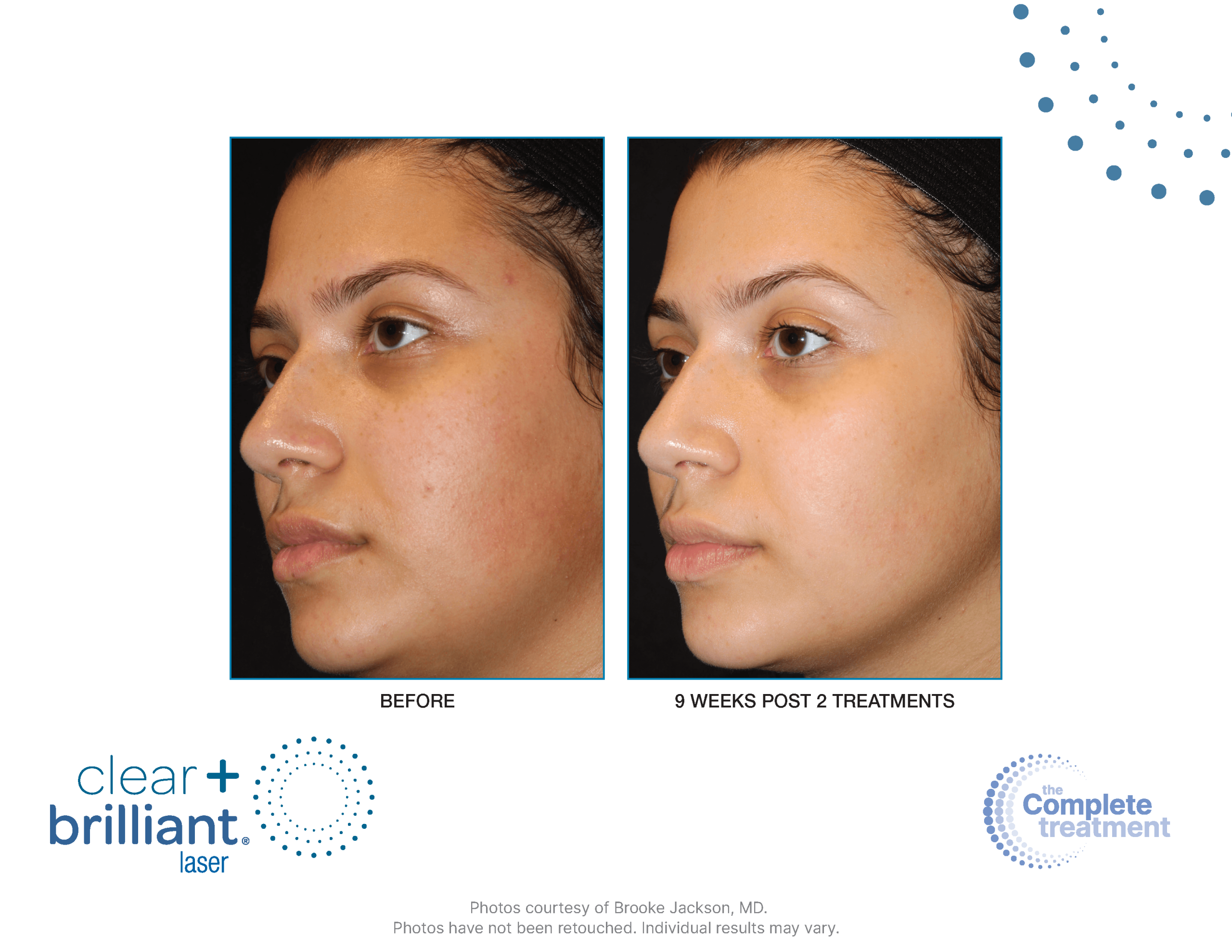 Clear + Brilliant before and after results at Deluxe Med Spa
