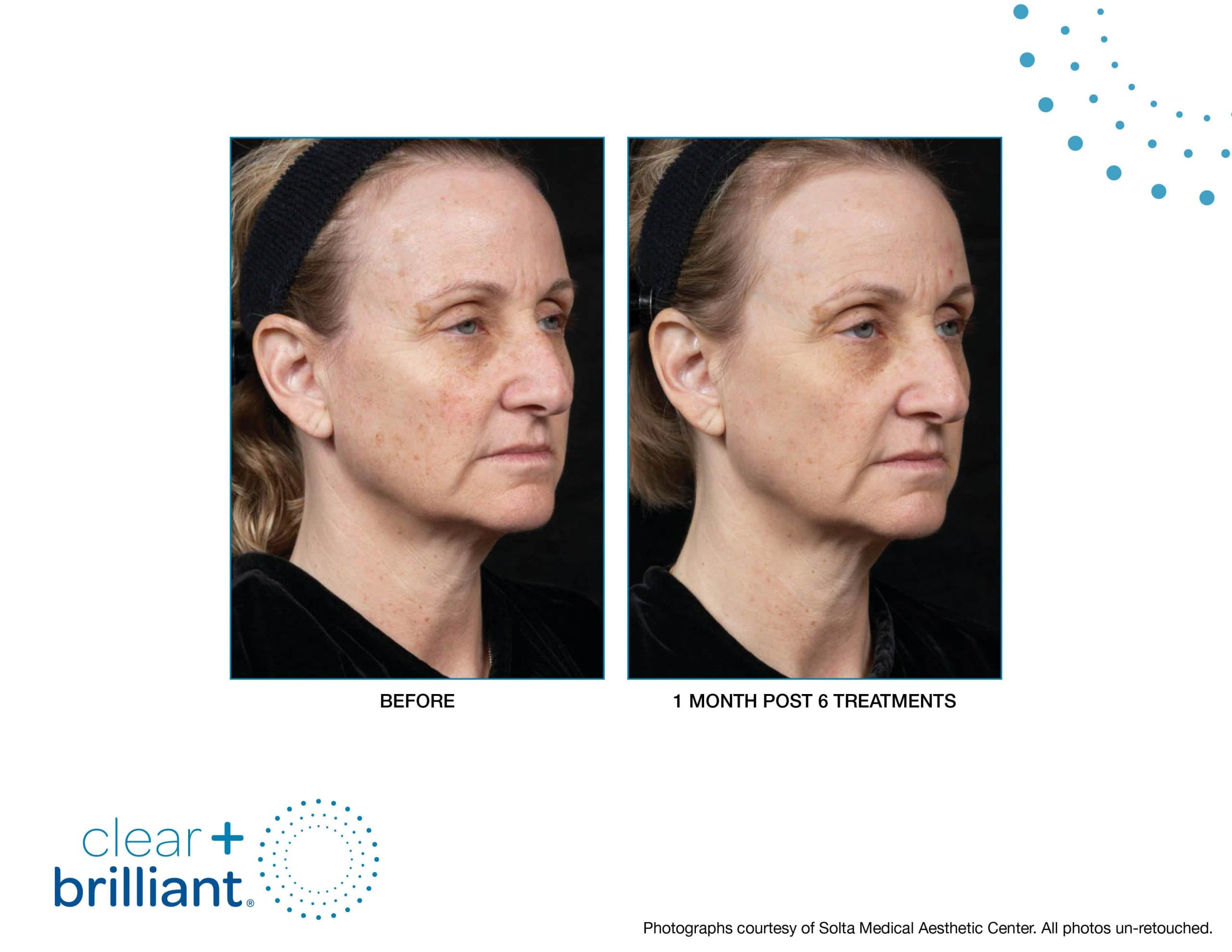 Clear + Brilliant before and after results at Deluxe Med Spa