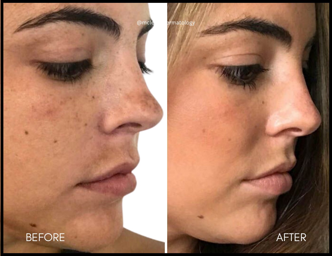 Clear + Brilliant before and after results at Deluxe Med Spa